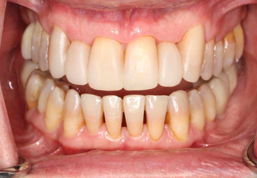 10.fin carillas composite