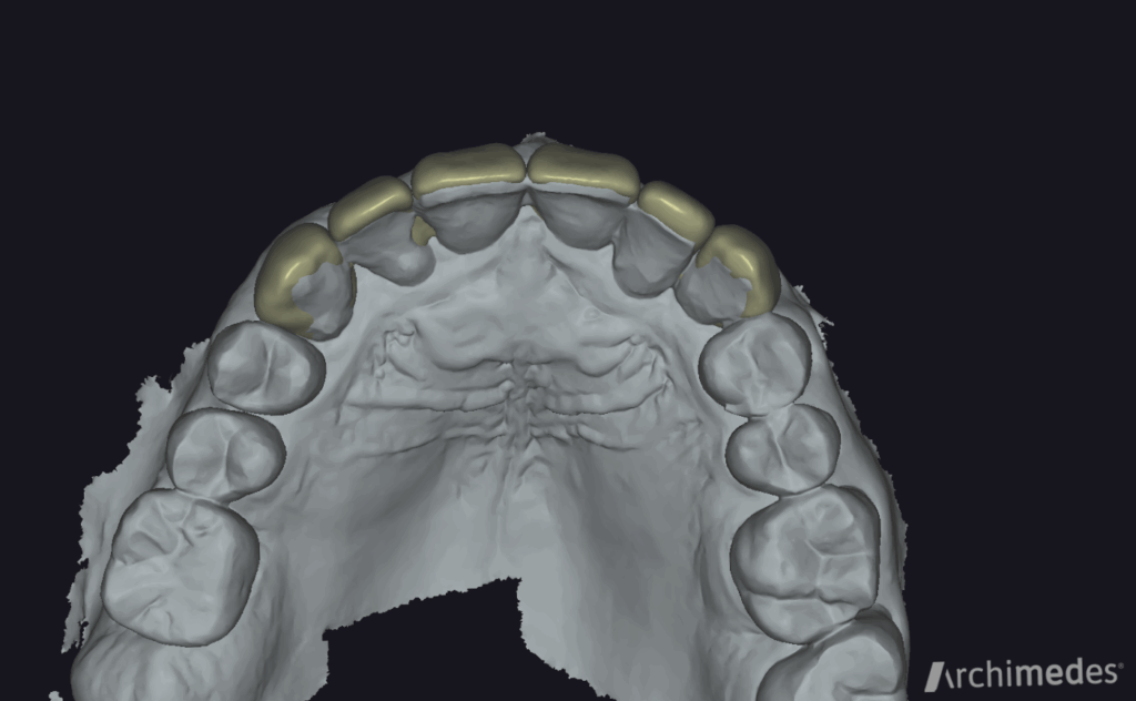 9.diseño carillas composite
